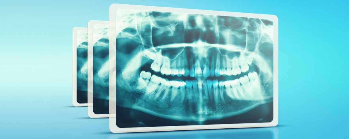 Radiographie dentaire