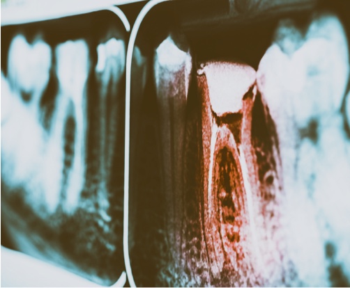 Radiographie rétrocoronaire