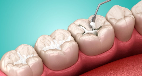 Les bénéfices des scellants dentaires pour enfants et adultes